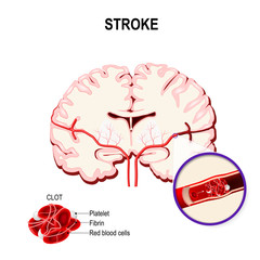 Ischemic stroke in the cerebral artery and thrombus.