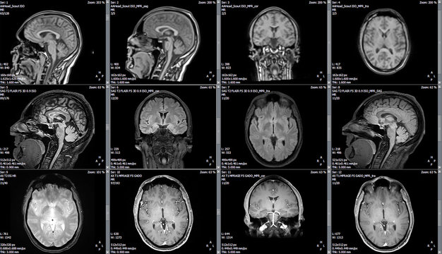 Magnetic resonance image (MRI) of a brain