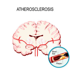 Cross section of the brain Human brain with atherosclerosis.