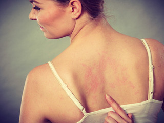 woman scratching her itchy back with allergy rash