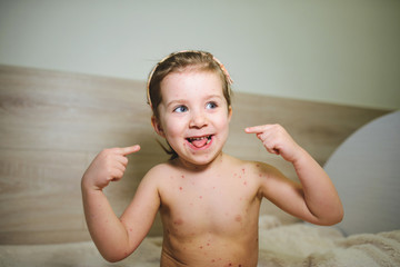 Girl Pointing at Face with Red Spots