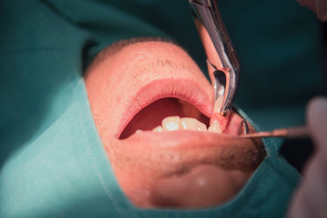 Caries tooth extraction by the dentist. Dentistry in hospital.   - 138071638