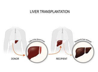 Liver transplantation or hepatic transplantation
