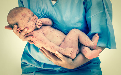 Newborn baby with chickenpox © andriano_cz