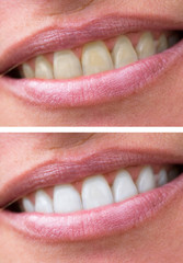 woman teeth before and after whitening