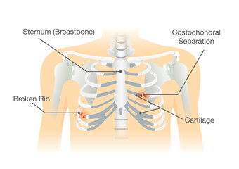 Human rib bone fractures fracture. Illustration is description of body injury. © logo3in1