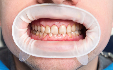 Dental fluorosis