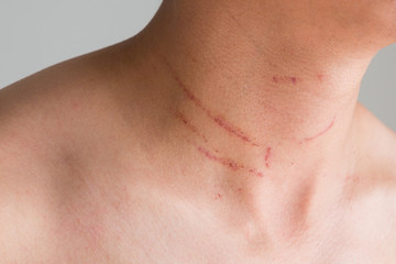CloseUp of scar on neck.