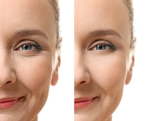 Mature woman face before and after cosmetic procedure. Plastic surgery concept.