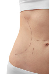 Female tummy on white background. Plastic surgery concept