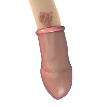 Common locations of genital warts, Human papillomavirus HPV lesions in men. 3D illustration showing ineffectiveness of comdom in protection against HPV transmission