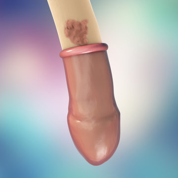 Common locations of genital warts, Human papillomavirus HPV lesions in men. 3D illustration showing ineffectiveness of comdom in protection against HPV transmission