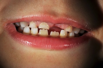 Obraz premium Milchzahngebiss eines 6-jährigen Jungen (Dens&nbsp;caducus)