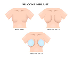 breast implant . cosmetic surgery vector