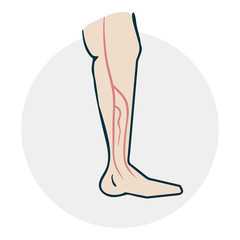 Leg with varicose veins