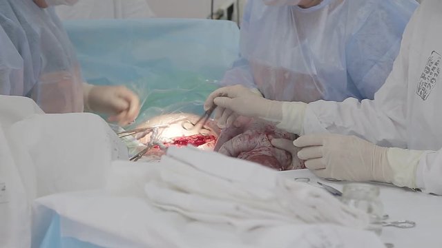 Doctor surgeon takes out newborn baby caesarean section