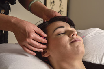 Obraz na płótnie Canvas Acupuncture Hands On Head Chinese Medicine