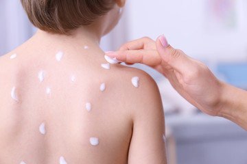 Woman applying cream onto skin of child ill with chickenpox, closeup