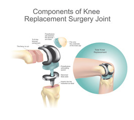 Components of knee replacement surgery joint.