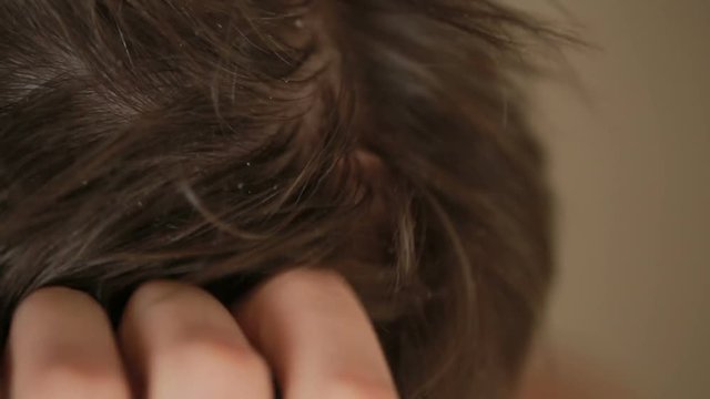 dandruff hair on men, closeup, man scratches his head.