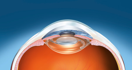 Human eye with artifical lens, medical illustration - obrazy, fototapety, plakaty
