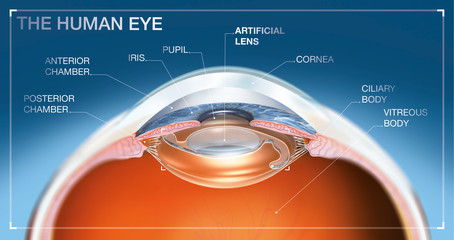 Human eye with artifical lens, medical illustration