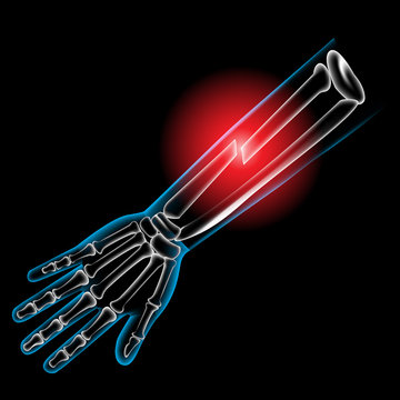 Arm bone and finger bone, pain, x ray, broken arm