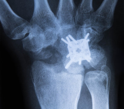 Versteifungsoperation - Handchirurgie