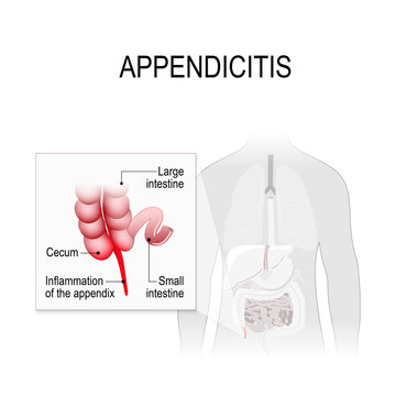Appendicitis. Location in the human digestive system