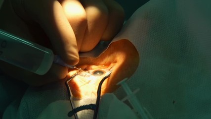 anesthesia before laser surgery vision correction, ophthalmology operation, Surgeon's hands in gloves performing laser eye vision correction correction, surgery eye, Cataract surgery