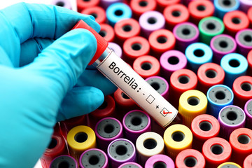 Fototapeta premium Blood sample positive with Borrelia test, Lyme disease diagnosis