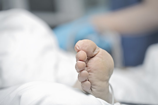 Lifeless feet of critically ill patient