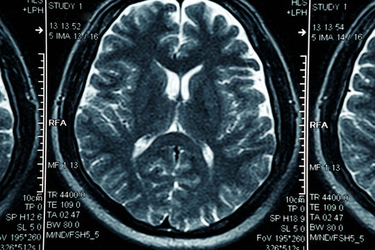 MRI or magnetic resonance image of head and brain scan. Close up view