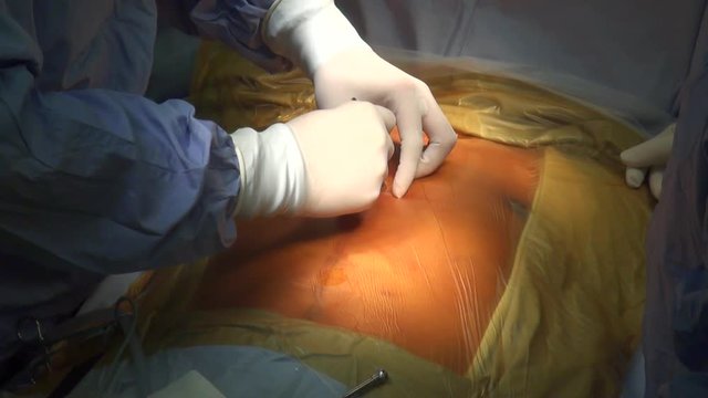 Cardiac surgeons performing a cardiac surgery, coronary artery bypass surgery