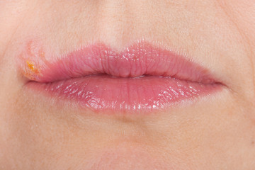 Herpes on the lip close up macro