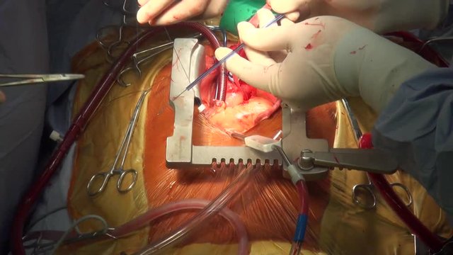 Heart valve surgery. Doctors perform surgery on open heart 
