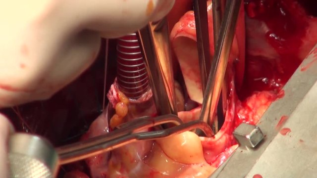 Heart valve surgery. Doctors perform surgery on open heart 