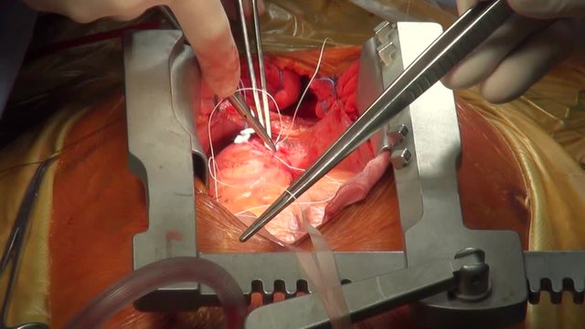 Heart valve surgery. Doctors perform surgery on open heart 