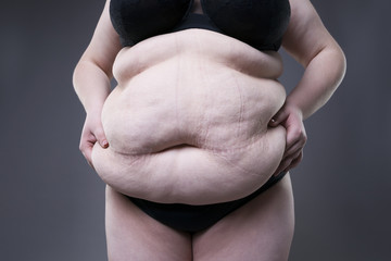 Fat female belly, overweight body, woman with stretch marks on abdomen