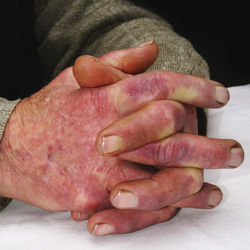 Closeup of the wrinkled hands of an old caucasian man