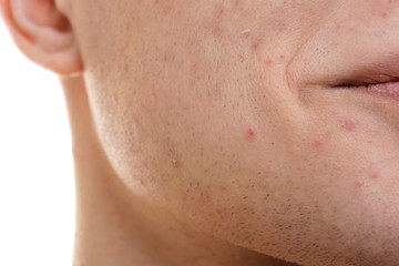 Face of handsome young man with problem skin, closeup