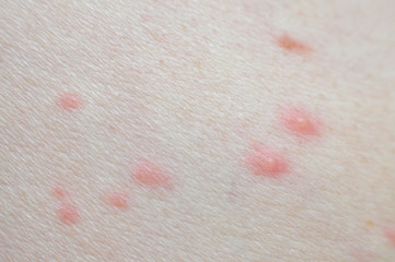 Fototapeta premium Chickenpox (varicella) closeup. Pox or smallpox closeup