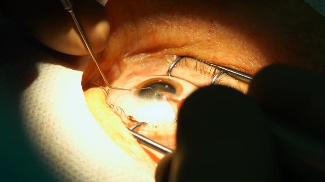 anesthesia before laser surgery vision correction, ophthalmology operation, Surgeon's hands in gloves performing laser eye vision correction correction, surgery eye, Cataract surgery
