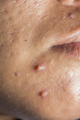 Fototapeta premium closeup for two acne on chin