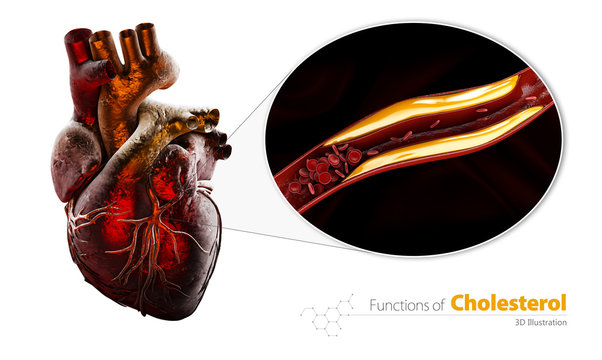 Blocked blood vessel, artery with cholesterol buildup, 3d Illustration isolated white