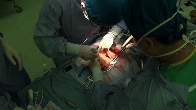 Total gastrectomy. Surgery for stomach cancer