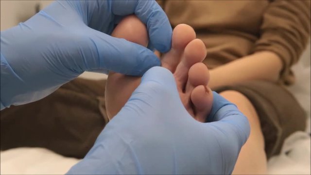 Dermatologist surgeon performs medical examination on foot to find the plantar wart exactly position