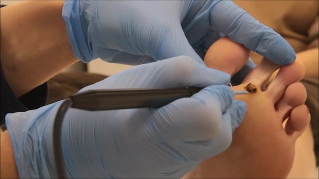 Dermatologist surgeon operates to remove plantar wart under the foot using electro scalpel