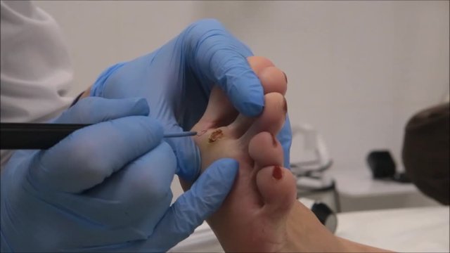 Dermatologist surgeon operates to remove plantar wart under the foot using electro scapel	