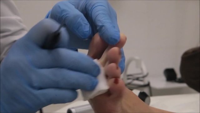 Dermatologist surgeon operates to remove plantar wart under foot using electro scalpel on middle age patient	